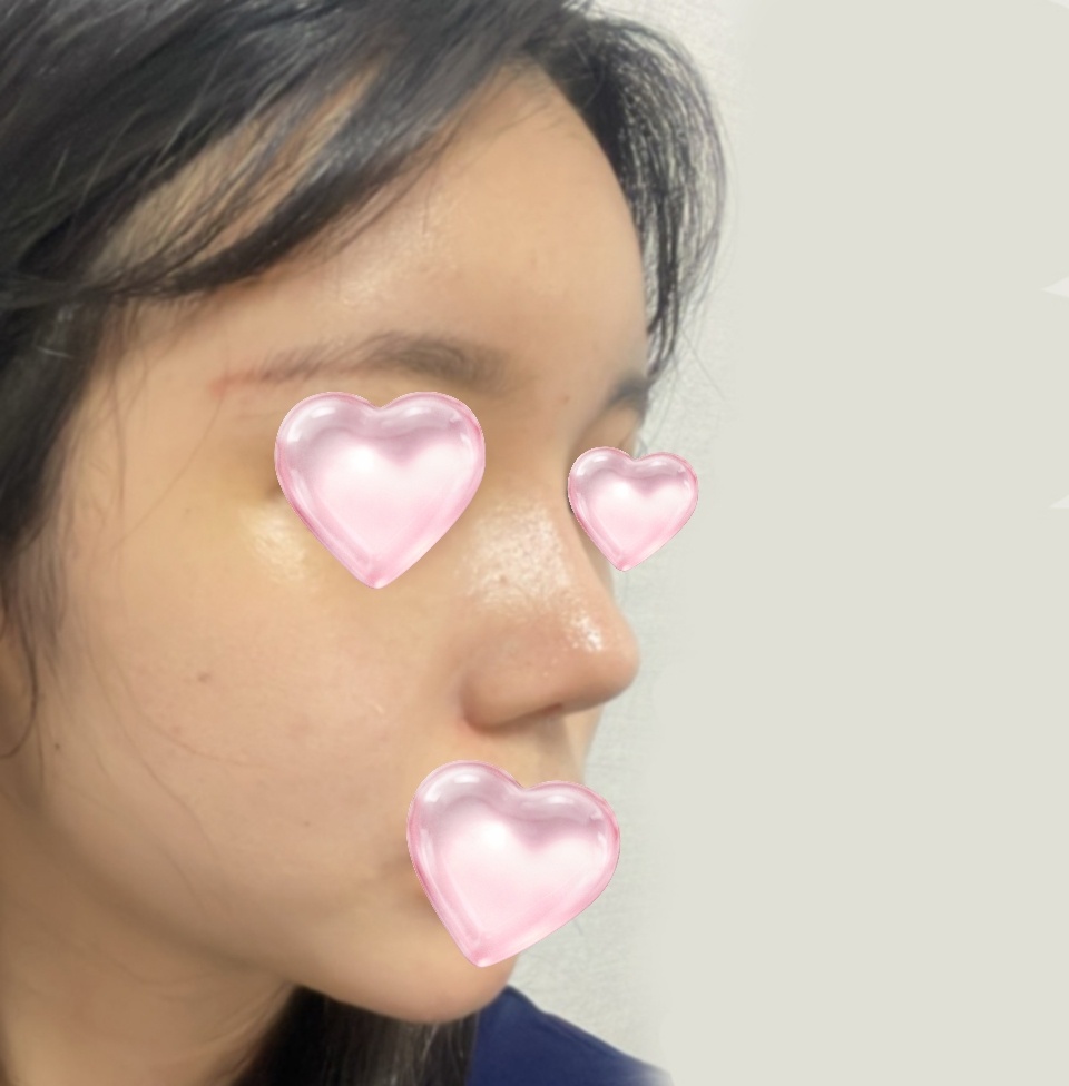 코랑 지방이식 후기! 기대이상으로 잘됐음요 ㅎㅎ