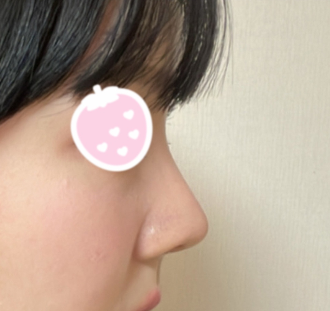 무보형물코수술한지 1달됐네요!