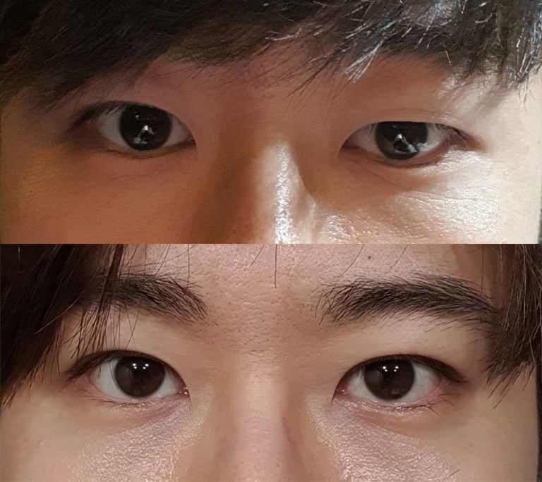 짝눈성형 너무 잘됐습니다.