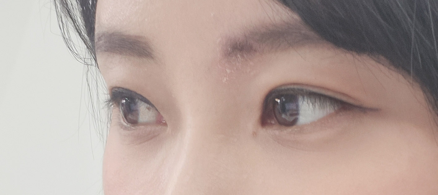수술후_2_-눈.jpg