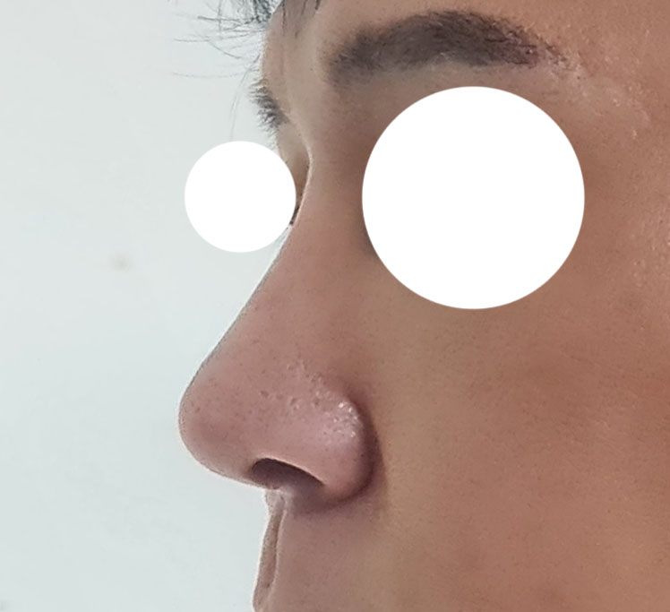 코수술후기 남겨봅니다