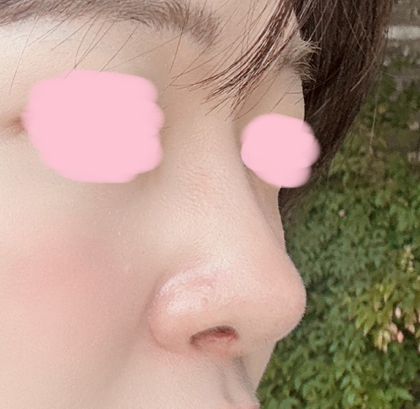 어느덧 코수술 5개월차됐습니당