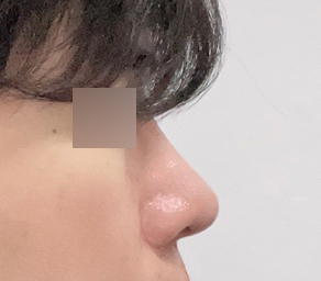 첫코성형 만족입니다bb