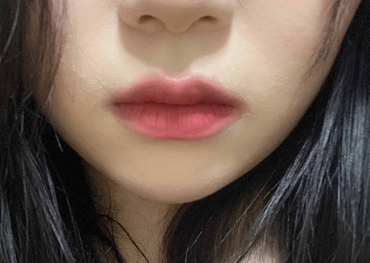 턱끝필러+이중턱흡입 조합 쵝오!