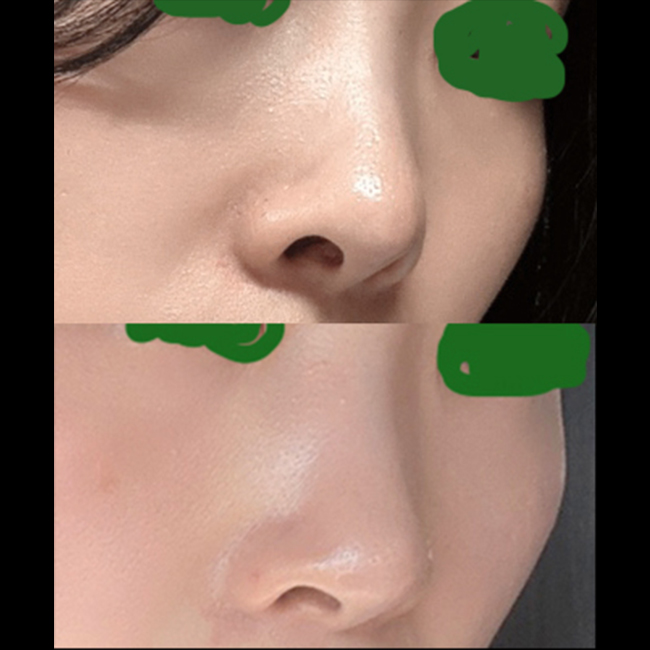 용코교정 제대로 된 후기!