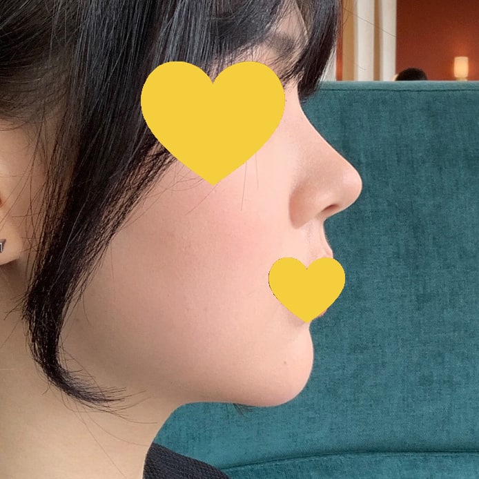 자연유착 재수술, 트임수술, 눈매교정 후기^^