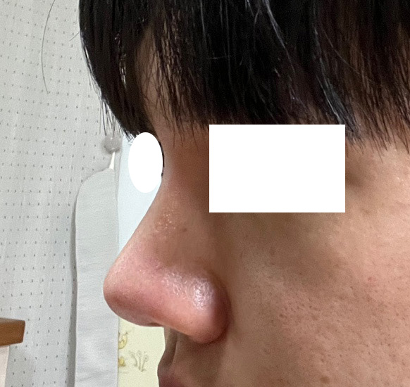 눈+코수술 5개월차인데 원래 제꺼같네요 ㅎㅎ굿