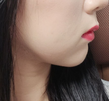 얼굴지방흡입 매우 만족!!!원장님 짱