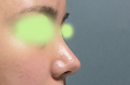 코재수술하고 자신감 올라갔어요