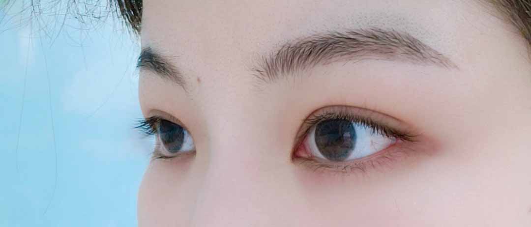 이마거상&부분절개눈매교정 했어요~