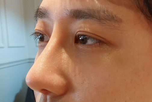 쌍수, 코수술했습니다~!