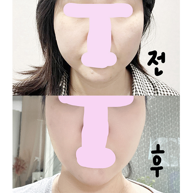 2._수술전후정면.jpg