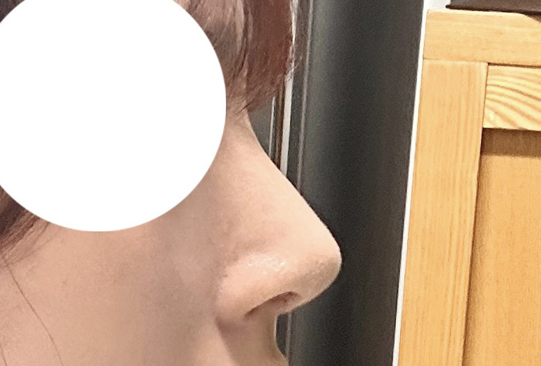 코수술대만족bb 원장님 실력 좋으십니다:)