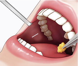 심부볼지방제거 Step 03