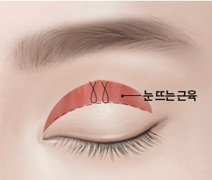 절개 눈매교정 Step 03