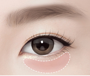 눈밑지방재배치 Step 01