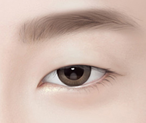 상안검성형술 Step 01