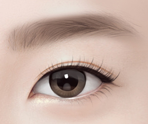 하안검성형술 Step 04