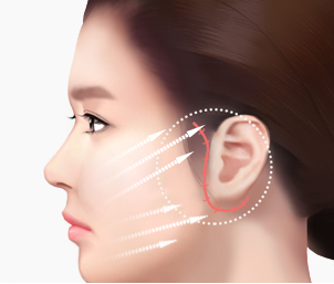 절개리프팅 Step 03