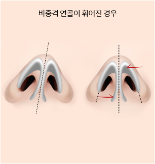 휜코 수술 Step 03