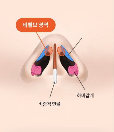 비밸브협착증