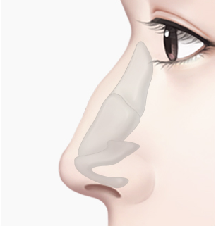 매부리코 수술 Step 01