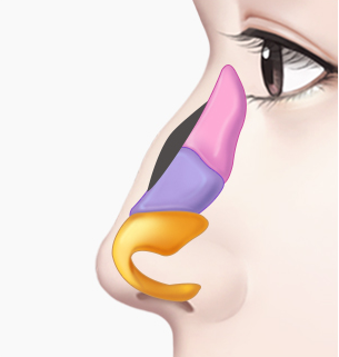 매부리코 수술 Step 02