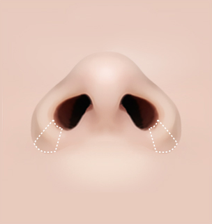 콧볼축소 Step 02