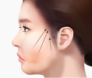 실리프팅 Step 03